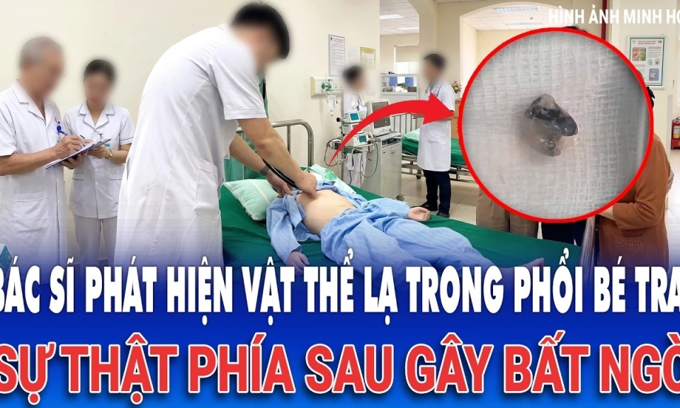 B&aacute;c sĩ ph&aacute;t hiện vật thể lạ trong phổi b&eacute; trai