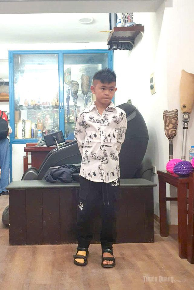 Em Vàng Văn Nguyễn, học sinh lớp 6, Trường Phổ thông Dân tộc bán trú Tiểu học và THCS Bản Ngò, xã Pà Vầy Sủ, được lắp chân giả, giúp em đi lại thuận tiện hơn.